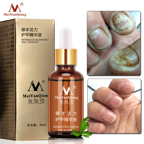 Herbal Nail Fungus Treatment Essence Serum Care Hand and Foot Care Removal Repair Gel Anti-infective Paronychia Onychomycosis ► Photo 1/6
