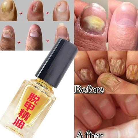 Effective Fungus Removal Essence oil Liquid Fungal Nail Treatment Bright Nail Repair Anti Infection Foot Caring Onychomycosis ► Photo 1/6