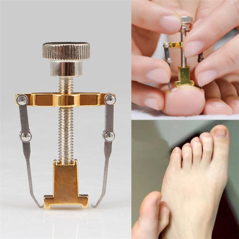 Ingrown Toenail Corrector Pedicure Toenail Fixer Foot Nail Care Orthotic Stainless Steel Treatment Onyxis Bunion Correction Tool ► Photo 1/6