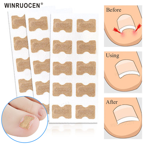 10pcs/set  Professional Ingrown Toenail Correction Tool Embedded Toe Nail Corrector Elastic Patch Sticker Pedicure Tool ► Photo 1/6