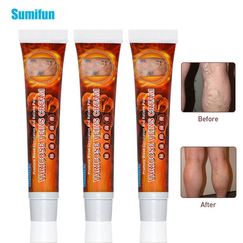 Sumifun 3pcs Treatment For Varicose Veins Chinese Herbal medicine For Varicosity Angiitis Removal Phlebitis legs Veins Ointment ► Photo 1/6