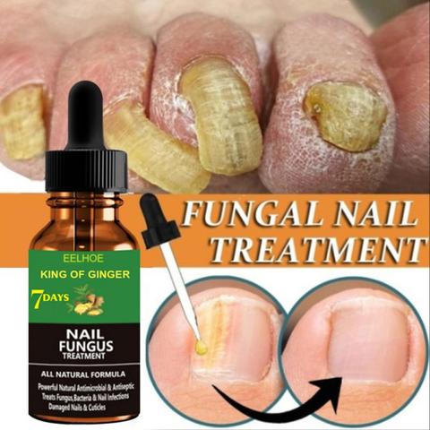 Nails-Care-Repair Nail-Fungal-Treatment Anti-Fungus Onychomycosis-Removal Liquid Ginger Foot Antifungal Nail Essence 20/30/50ml ► Photo 1/6