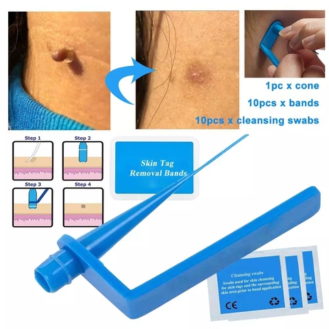 Micro Band Non Toxic Face Care Mole Wart Tool For Small To Medium Blue Skin Tag Removal Kit With Cleansing Swabs Home Use Adult ► Photo 1/6