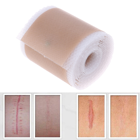 Efficient Surgery Scar Removal Silicone Gel Sheet Therapy Patch for Acne Trauma Burn Scar Skin Repair Scar Treatment 4x150cm ► Photo 1/6