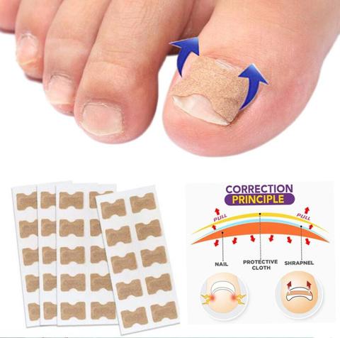 30pcs Non-Glue Toenail Patch Correction Stickers Ingrown Toenail Correction Pedicure Tool Toe Inlay Nail Corrector Nail Patch ► Photo 1/6