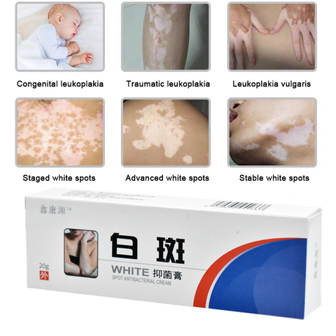 20g Chinese Medical White Spot Disease Cream Pigment Melanin Promoting Liniment Skin Vitiligo Leukoplakia Disease Treatment ► Photo 1/6
