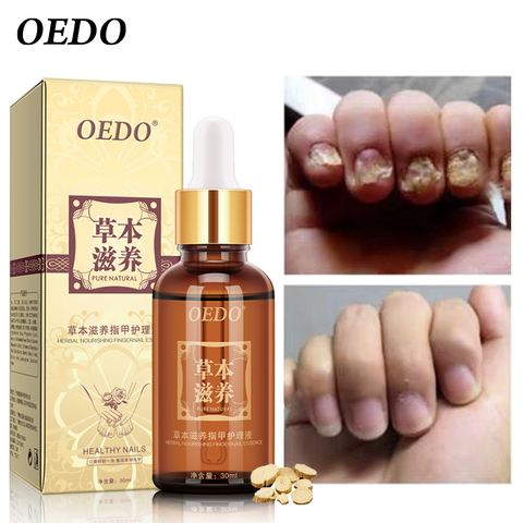 Herbal Fungal Nail Treatment Essential oil Hand and Foot Whitening Toe Nail Fungus Removal Infection Feet Care Polish Nail Gel ► Photo 1/6