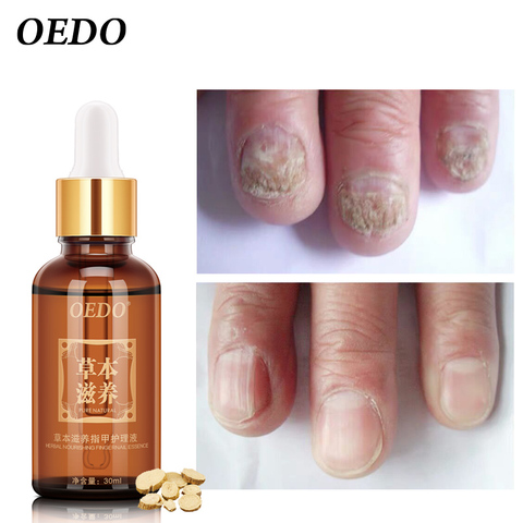 OEDO Healthy Nail Care Herbal Fungus Nail Repair Essential Oil Hand and Foot Bright White Toe Nail Remove Fungus Infected Nail ► Photo 1/6
