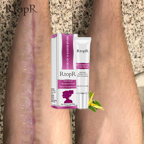 RtopR Acne Scar Stretch Marks Remover Cream Skin Repair Face Cream Acne Spots Acne Treatment Blackhead Whitening Cream Skin Care ► Photo 1/6