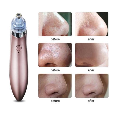 Blackhead Remover Face Deep Nose Cleaner T Zone Pore Acne Pimple Removal Vacuum Suction Facial Diamond Beauty Clean Skin Tool ► Photo 1/6