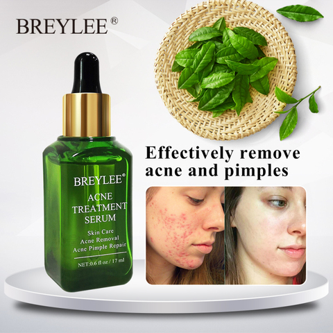New Acne Treatment Face Serum Mask Anti Acne Pimple Scar Remover Moisturizing Whitening Skin Care Facial Cream 17mlTSTM1 ► Photo 1/6