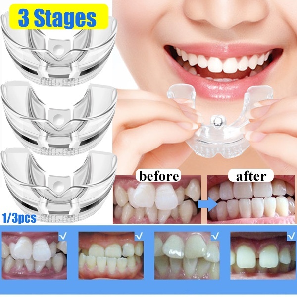 Price History Review On 3 Stages Dental Orthodontic Braces Appliance Braces Alignment Trainer Teeth Retainer Bruxism Mouth Guard Teeth Straightene Aliexpress Seller Home Life Store Alitools Io