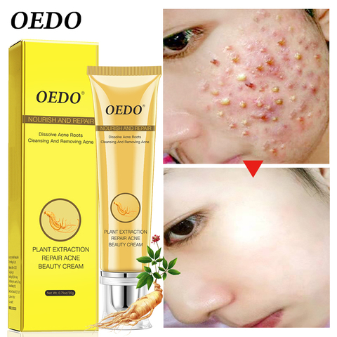 Acne Treatment Blackhead Remova Anti Acne Cream Oil Control Shrink Pores Acne Scar Remove Face Care Whitening ► Photo 1/6