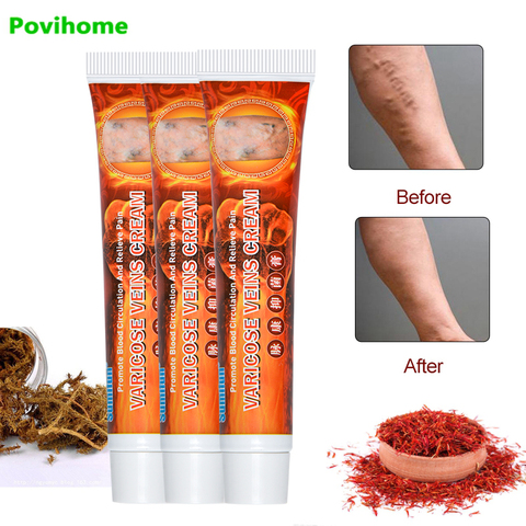 3pcs Varicose Veins Treatment Cream Varicosity Angiitis Remedy Ointment Vascular Inflammation Varicose Vein Pain Relief Ointment ► Photo 1/6