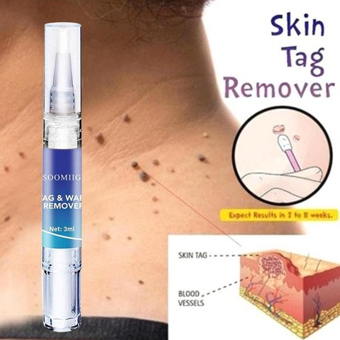 3ml Liquid Genital Wart Treatment Papillomas Removal Of Warts Skin Tags Removing Against Moles Remover Anti Verruca Remedy ► Photo 1/6