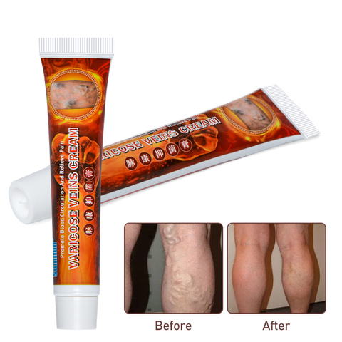 2022 100% Original New Varicose Veins Treatment Cream Vasculitis Phlebitis Spider Pain Relief Ointment Medical Plaster QCWQ ► Photo 1/6