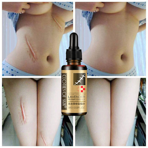 LAIKOU Essential Massage oils Scar Removal Lavender Oil For Pregnant Women Hyaluronic Acid Serum Oil Essential Face Anti Acne ► Photo 1/6