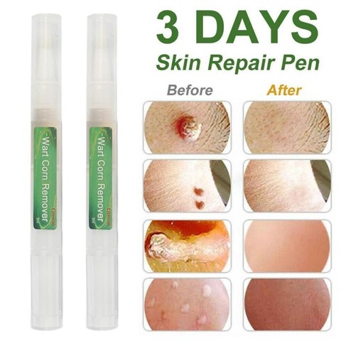 3 Days Skin Tag Genital Wart Remover Pen Herbal Extract Serum Mole Wart Skin Tag Foot Corn Warts Treatment Skin Tag Removal ► Photo 1/6