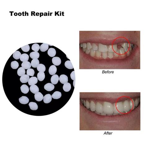 10g/100g Denture Solid Glue Dental Restoration Temporary Tooth Repair Kit Oral Care Tool ► Photo 1/6