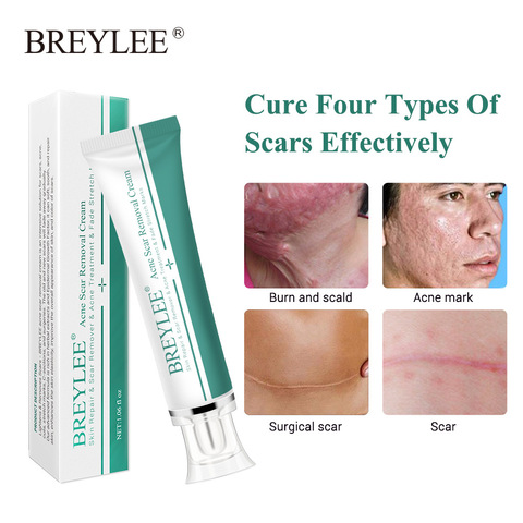 NEW 30g Acne Scar Removal Cream Skin Repair Face Cream Acne Spots Acne Treatment Whitening Cream Stretch Marks Skin Care TSLM2 ► Photo 1/6