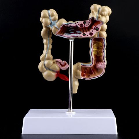 Human Colorectal Lesion Model Pathological Anatomy Colon Diseases Intestine Medical Teaching Learning Tool ► Photo 1/6