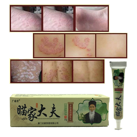 Skin Psoriasis Cream Dermatitis Eczematoid Eczema Ointment Treatment Psoriasis Cream Skin Care Cream ► Photo 1/6