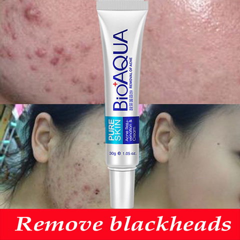 Bioaqua 30g Acne Treatment Blackhead Remova Anti Acne Cream Oil Control Shrink Pores Acne Scar Remove Face Care Whitening ► Photo 1/6
