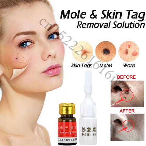 Mole & Skin Tag Removal Solution Painless Mole Skin Dark Spot Removal Face Wart Tag Freckle Removal Cream Oil Plaster ► Photo 1/4