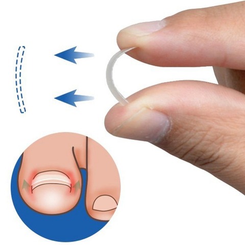 10Pcs Ingrown Toenail Correction Tool Ingrown Toe Nail Treatment Elastic Patch Sticker Straightening Clip Brace Pedicure Tools ► Photo 1/6