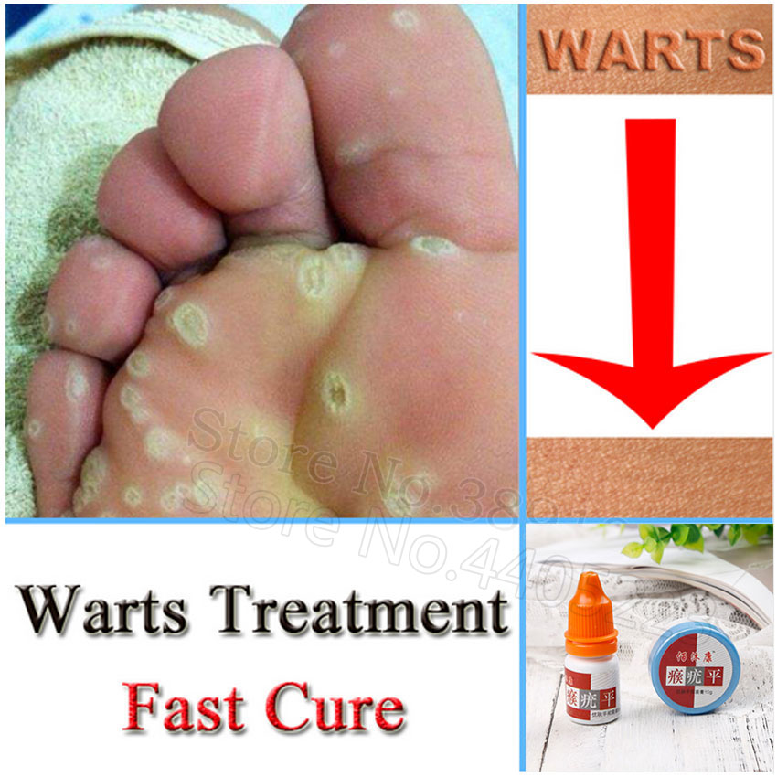 warts toes treatment