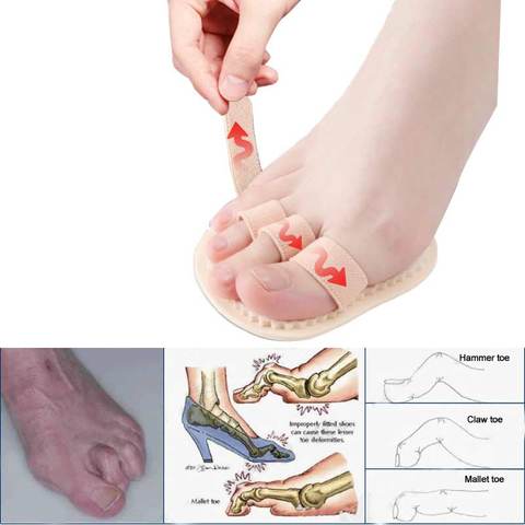 1 Pair Hammer Mallet Toe Separator Hallux Valgus Orthopedic Pads Orthotics Bending Deformation Overlap Foot Toe Correction Socks ► Photo 1/6
