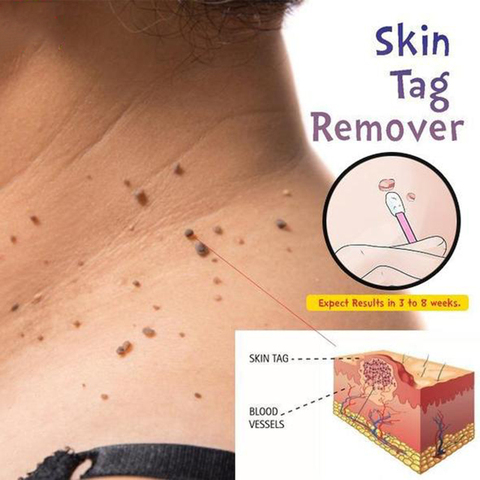 Skin Tag Mole Wart Remover Eye Skin Tag Remover 12 Hours Remover 10ml ► Photo 1/6