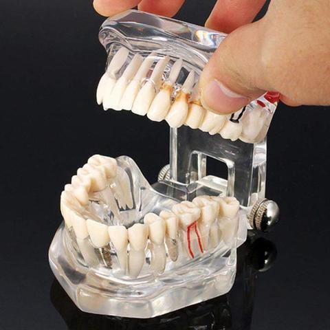 New Dental Model Teeth Implant Restoration Bridge Teaching Study Medical Science Disease Dentist Dentistry Products ► Photo 1/6