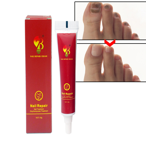 Anti Fungal Treatment Nail ointment Onychomycosis Paronychia Infection Herbal Toe Finger Nails Health Nail Fungus Treatment Mass ► Photo 1/6