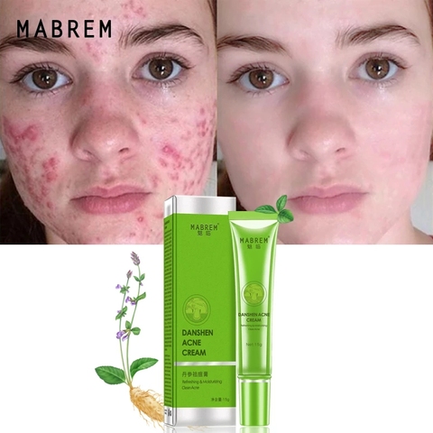 MABREM Acne Treatment Skin Care Remove Acne Oil Control Oil Shrink Pores Whitening and Moisturizing Scar Removal Facial cream ► Photo 1/5