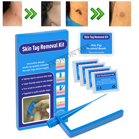home use skin tags remover kit remove warts body skin care tools wart treatment face Skin Tag Removal Tool Acne Tag Remover band ► Photo 1/6