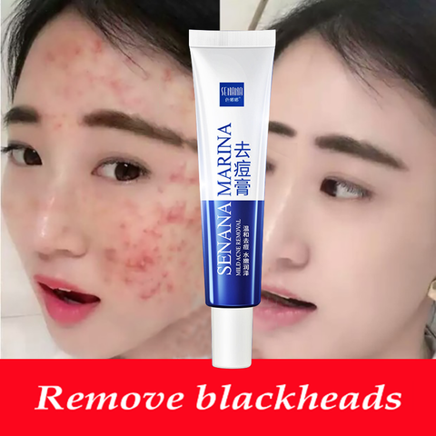 LAIKOU Acne Treatment Gel Blackhead Remove Face Cream Shrink Pores Scar Remove Anti Acne Whitening Face Cream Skin Care ► Photo 1/6