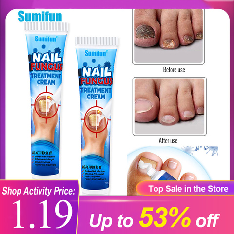 1Pcs Nail Fungus Removal Cream Onychomycosis Fungal Nail Treatment Paronychia Anti Infection Feet Toe Fungal Nail Care Ointment ► Photo 1/6