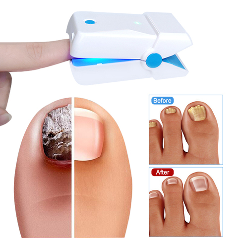 LASPOT 905nm Diode Cold Laser for Nail Fungus Treatment LLLT Fungal Nails Fungus Remover 2022 Home Physiotherapy Apparatus ► Photo 1/6