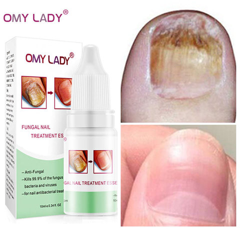 Buy Online Omy Lady Fungal Nail Repair Essence Serum Toe Nail Fungus Treatment Nails Gel Anti Infection Paronychia Onychomycosis Nails Care Alitools