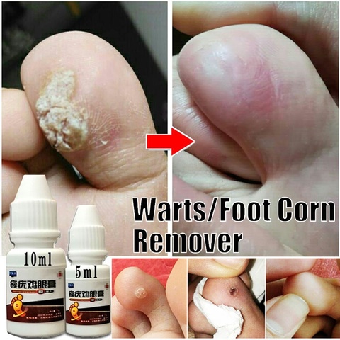 10ml/5ml Remover Foot Corn Care Cream Medical Plaster Treatment Warts Thorn Cream Corn of Removal foot Calluses Callosity Detox ► Photo 1/6