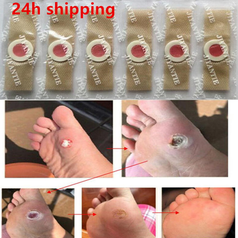 30pcs Foot Plaster Corn Removal Pads Medical Plasters Warts Thorn Patch  Curative Patches Calluses Callosity Detox Foot Patches ► Photo 1/6