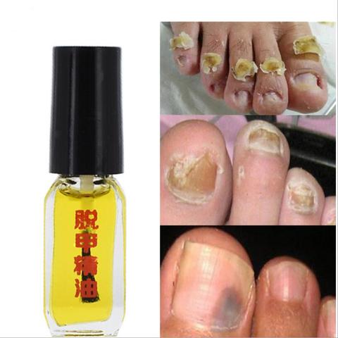 3 Days Effect Really work Nail Treatment Removal of onychomycosis Paronychia Anti oil Fungal Nail Infection Toe Nail Fungus oil ► Photo 1/6