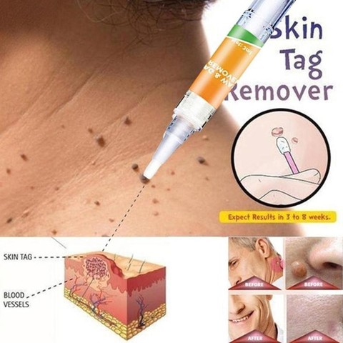 Skin Tag Remover Herbal Extract Foot Corn Plaster Warts Ointment Warts Remover Antibacterial Ointment Wart Treatment Cream ► Photo 1/6