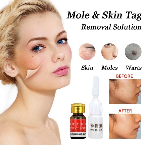 CVS MART Mole & Skin Tag Removal Solution Painless Mole Skin Dark