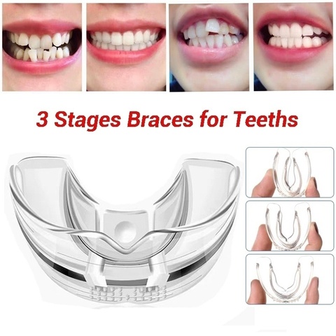 3 Stages Dental Orthodontic Braces Appliance Braces Alignment Trainer Teeth Retainer Bruxism Mouth Guard Teeth Straightener ► Photo 1/5