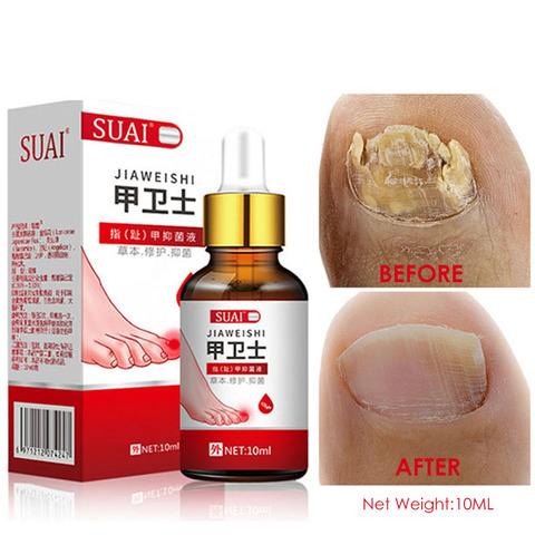 Nail Fungal Treatment Feet Care Essence Nail Foot Whitening Toe Nail Fungus Removal Gel Anti Infection Paronychia Onychomycosis ► Photo 1/6