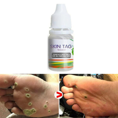 Chinese Medicine Treatment Skin Warts Removal Foot Corn Removal Plantar warts Pomada De Verruga Skin Care Medical Ointment ► Photo 1/6