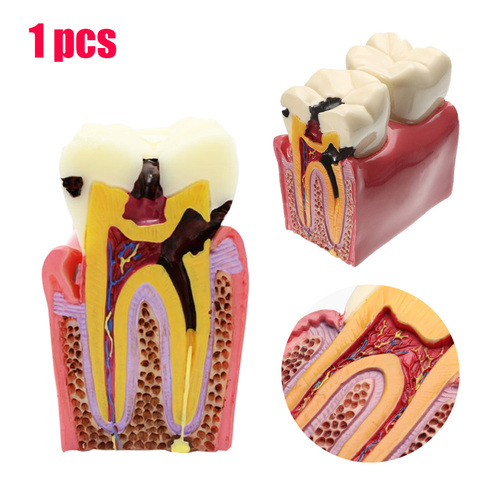 1pcs dental teeth model 6 Times Caries Comparation Study denture Tooth models Dentist Studying and Researching Dentistry product ► Photo 1/6