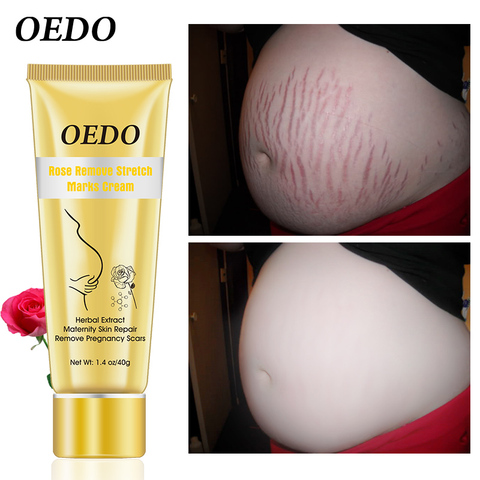 Pregnancy Scars Remove Stretch Marks Cream Treatment Maternity Repair Anti-Aging Anti-Wrinkles Firming Stretch Mark Body Creams ► Photo 1/6